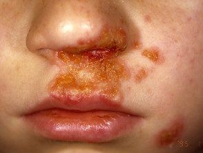 Staphylococcus (Staph) Enfeksiyonları