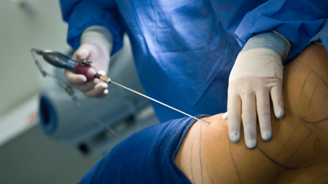 Liposuction Nedir? Sağlık Açısından Zararlı mı?