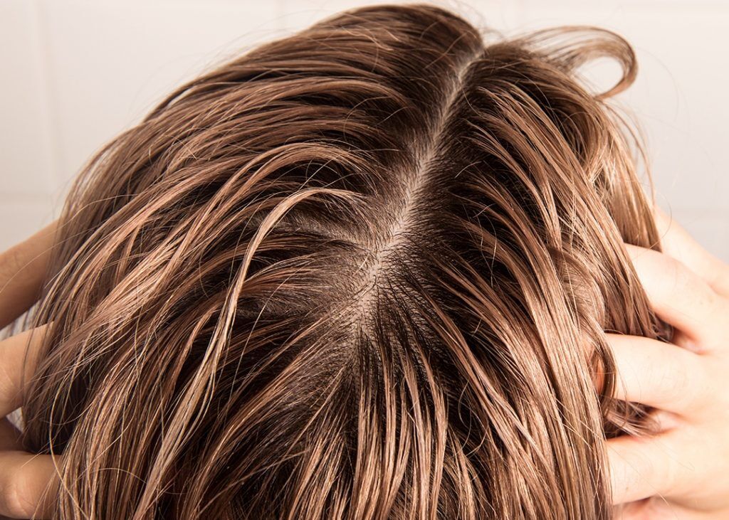 Yağlı Saçlarda Kuru Saç Derisinin En Yaygın Nedenleri ve Tedavi Yöntemleri