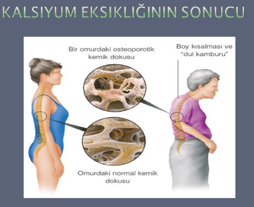 Dowager Kamburu nedir? Nasıl Tedavi Edilebilir, Nasıl Önlenebilir?