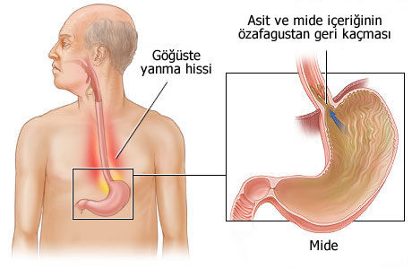 Asit Reflü İçin En İyi ve En Kötü İçecekler