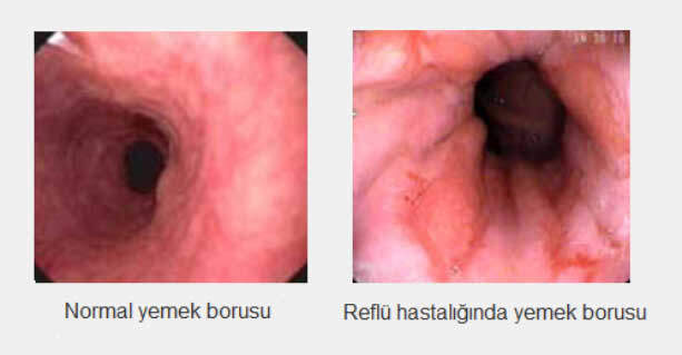 Asit Reflü İçin En İyi ve En Kötü İçecekler